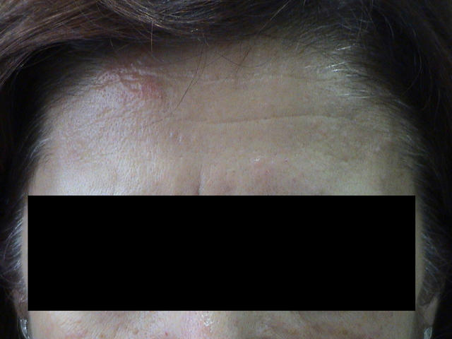 CONNECTIVE TISSUE DISORDERS - Dermatomyositis