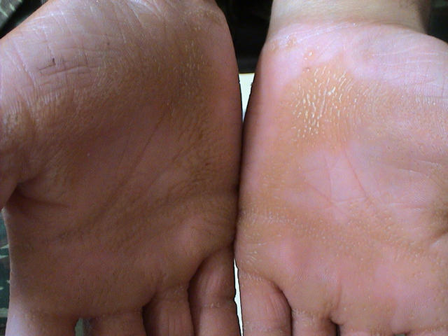 KERATINISATION DISORDERS - Palmar hyperkeratosis KERATINISATION DISORDERS - Palmar hyperkeratosis