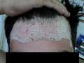 PSORIASIS - Plaque psoriasis