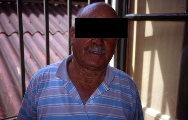 AGEING, PHOTOAGEING - Elastosis AGEING, PHOTOAGEING - Elastosis