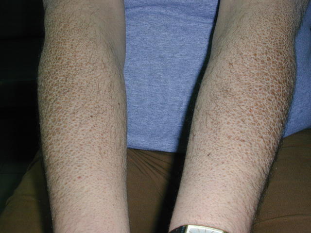 GENODERMATOSES - Ichtyosis vulgaris GENODERMATOSES - Ichtyosis vulgaris