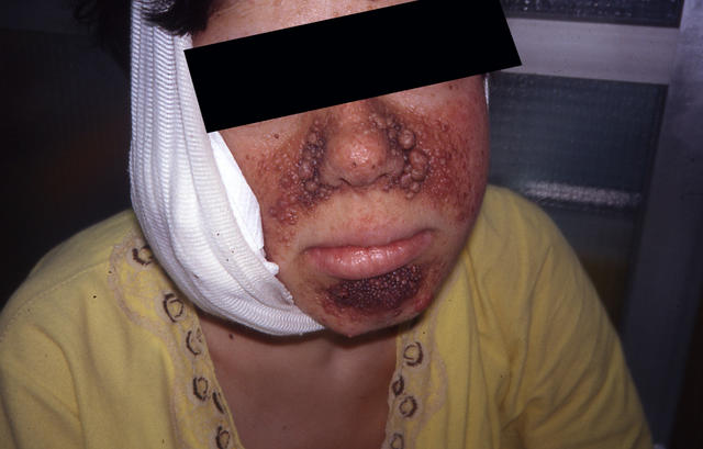 GENODERMATOSES - Tuberous sclerosis complex