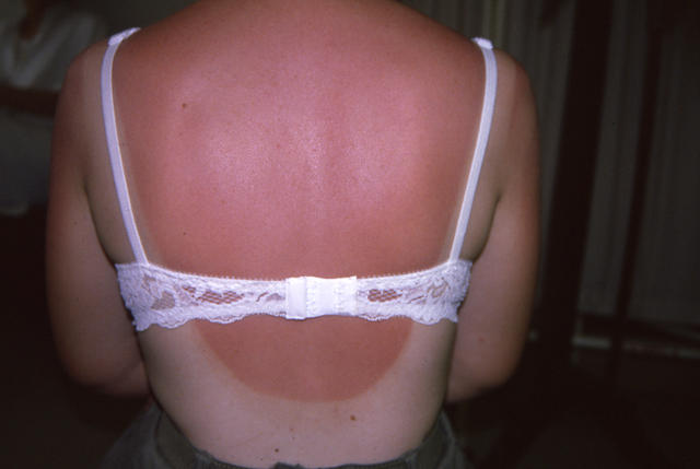 AGEING, PHOTOAGEING - Solar burn AGEING, PHOTOAGEING - Solar burn