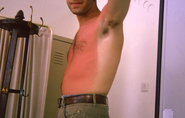 AGEING, PHOTOAGEING - Solar burn AGEING, PHOTOAGEING - Solar burn