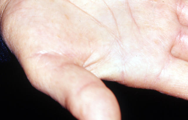 KERATINISATION DISORDERS - Darier disease KERATINISATION DISORDERS - Darier disease