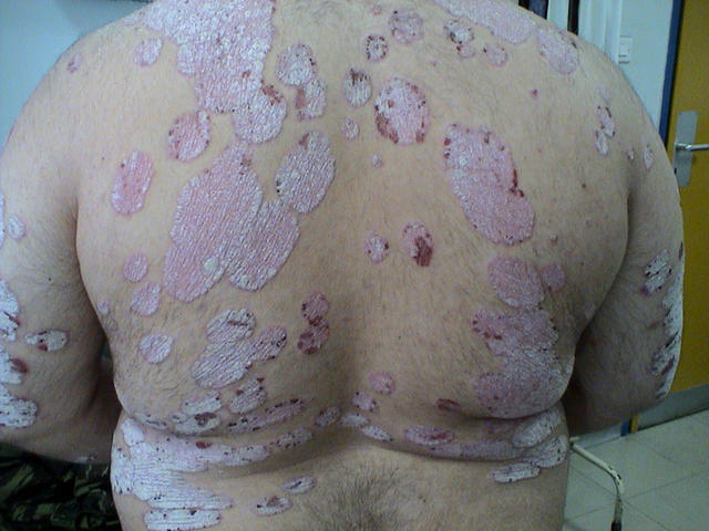 PSORIASIS - Plaque psoriasis