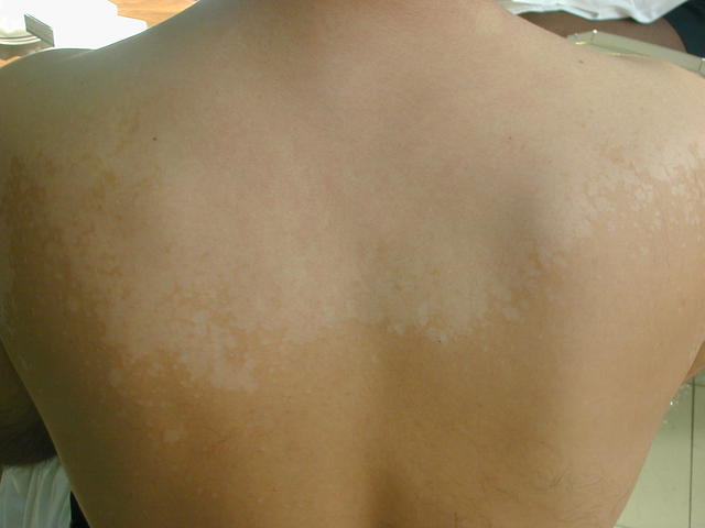 SUPERFICIAL FUNGAL INFECTIONS - Pityriasis versicolor SUPERFICIAL FUNGAL INFECTIONS - Pityriasis versicolor