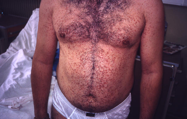 MASTOCYTOSES - Urticaria Pigmentosa