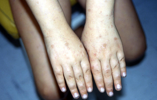 LICHEN - Lichen planus, annular LICHEN - Lichen planus, annular