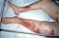 BULLOUS DISEASES - Bullous pemphigoid