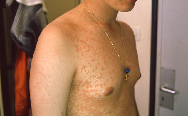 SUPERFICIAL FUNGAL INFECTIONS - Pityriasis versicolor