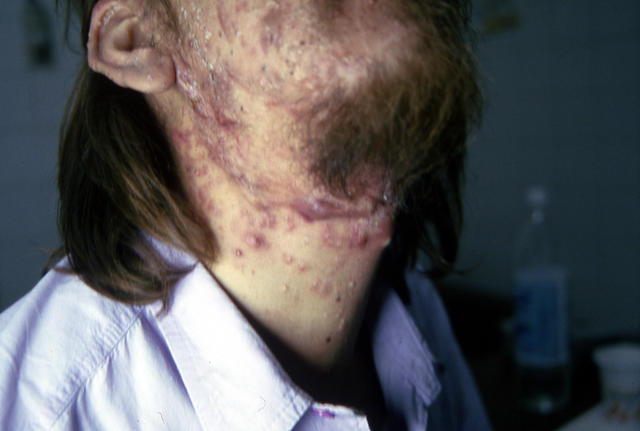 DISEASES OF THE SEBACEOUS GLANDS - Acne, Cystic DISEASES OF THE SEBACEOUS GLANDS - Acne, Cystic
