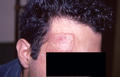 DERMATITIS - EKZEMA - Dermatitis