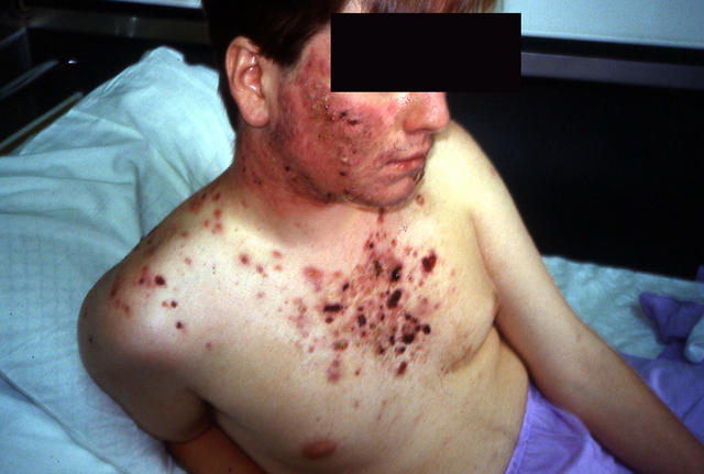 DISEASES OF THE SEBACEOUS GLANDS - Acne, Fulminans