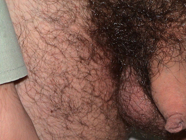 PARASITOSES, BITES - Lice PARASITOSES, BITES - Lice