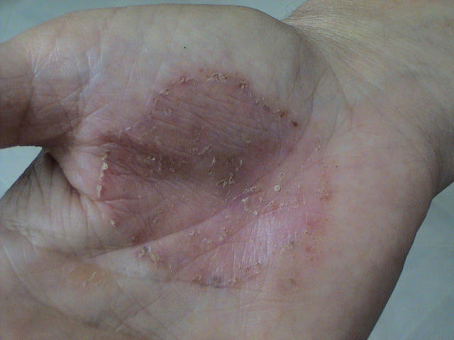 tinea infections