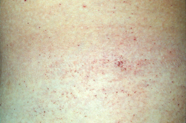 GENODERMATOSES - Fabry disease GENODERMATOSES - Fabry disease