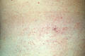 GENODERMATOSES - Fabry disease