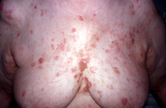 BULLOUS DISEASES - Pemphigus erythematosus