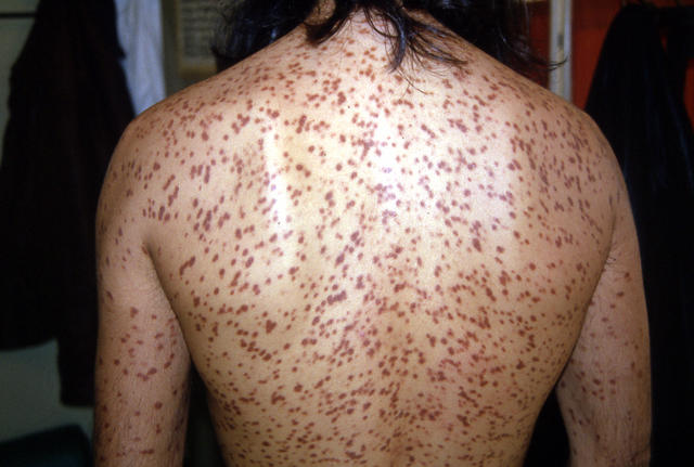 MASTOCYTOSES - Urticaria Pigmentosa