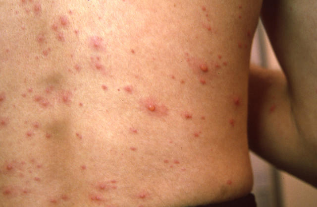 VIRAL INFECTIONS - SmallPox VIRAL INFECTIONS - SmallPox