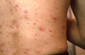 VIRAL INFECTIONS - SmallPox