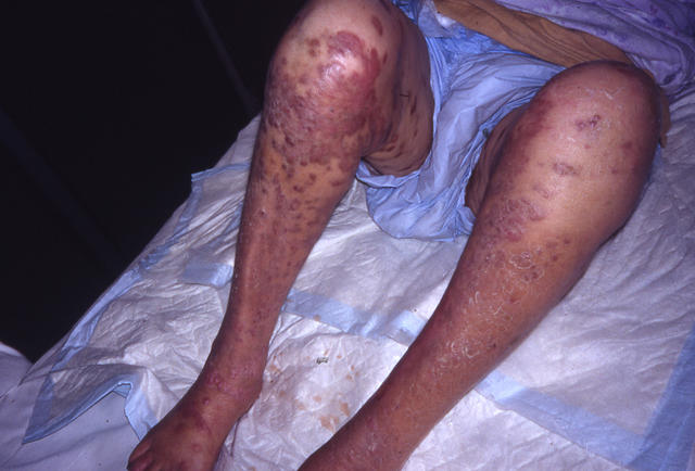 SOFT TISSUE TUMORS - Kaposi sarcoma