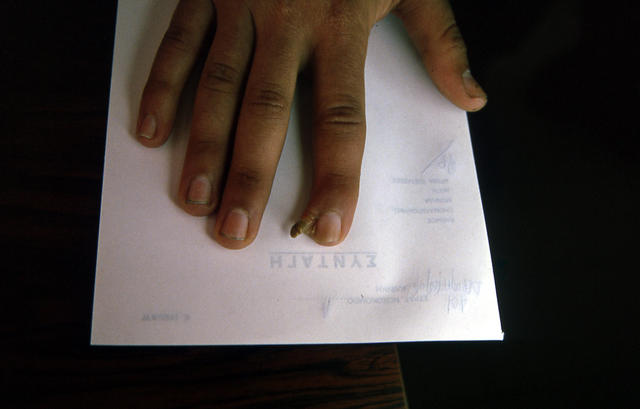 GENODERMATOSES - Auxilliary digit GENODERMATOSES - Auxilliary digit