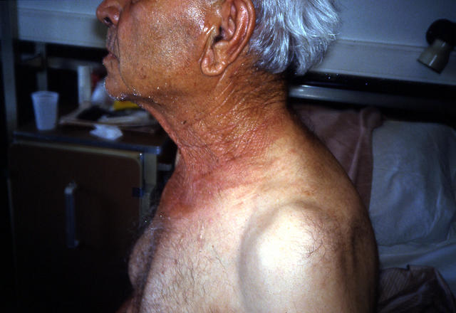 AGEING, PHOTOAGEING - Elastosis AGEING, PHOTOAGEING - Elastosis