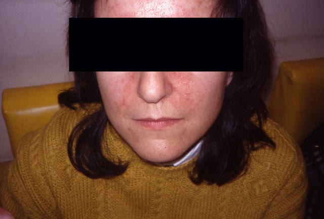 DERMATITIS - EKZEMA - Seborrheic Dermatitis