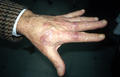 SUPERFICIAL FUNGAL INFECTIONS - Tinea infection