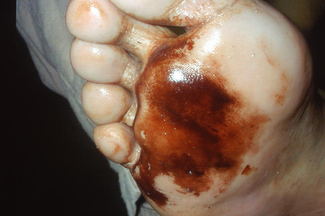 PIGMENTATION DISORDERS - Chromhidrosis PIGMENTATION DISORDERS - Chromhidrosis