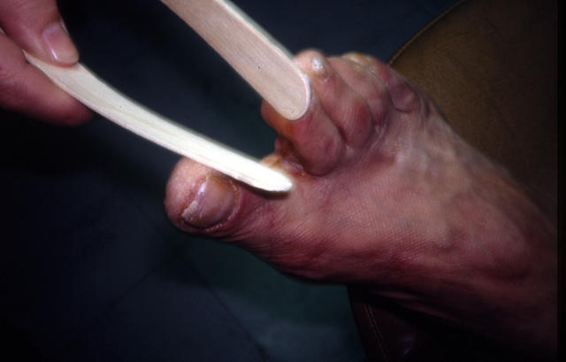 SUPERFICIAL FUNGAL INFECTIONS - Tinea pedis (Athlet's foot) SUPERFICIAL FUNGAL INFECTIONS - Tinea pedis (Athlet's foot)