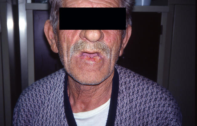 MALIGNANT LESIONS - Squamous Cell Carcinoma (SCC) of the lip MALIGNANT LESIONS - Squamous Cell Carcinoma (SCC) of the lip