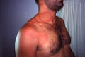 URTICARIA - Urticaria