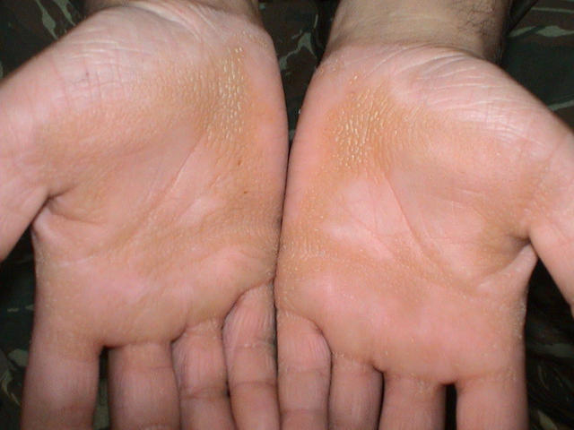 KERATINISATION DISORDERS - Palmar hyperkeratosis