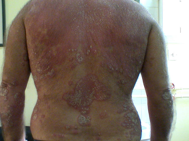 PSORIASIS - Generalized psoriasis PSORIASIS - Generalized psoriasis