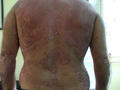 PSORIASIS - Generalized psoriasis