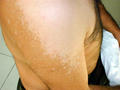 SUPERFICIAL FUNGAL INFECTIONS - Pityriasis versicolor