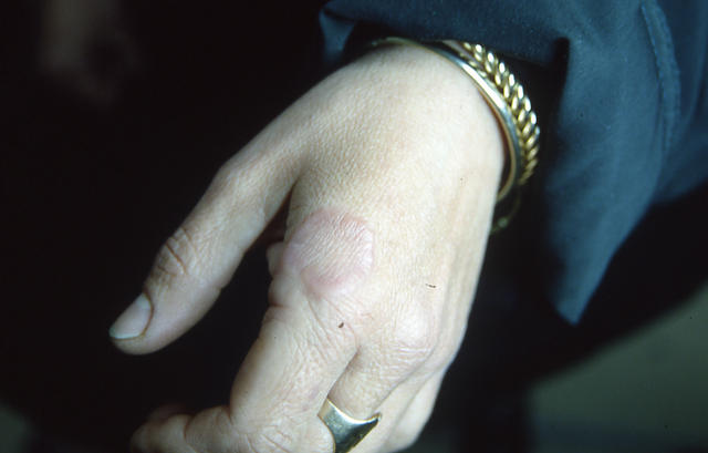 NECROBIOTIC DISORDERS - Granuloma Annulare