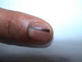 NAIL DISEASES - Linear Pigmented Nevus