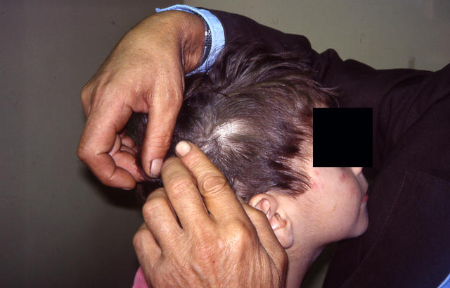 Picture of Ringworm of the Scalp (Tinea Capitis) - WebMD