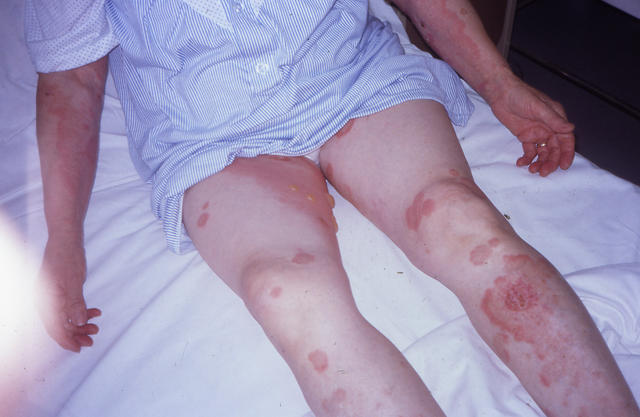 BULLOUS DISEASES - Bullous pemphigoid