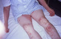 BULLOUS DISEASES - Bullous pemphigoid