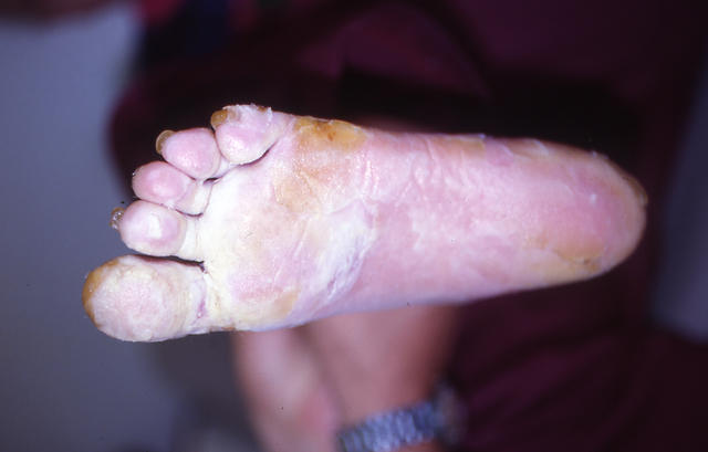 NAIL DISEASES - Pachyonychia congenita