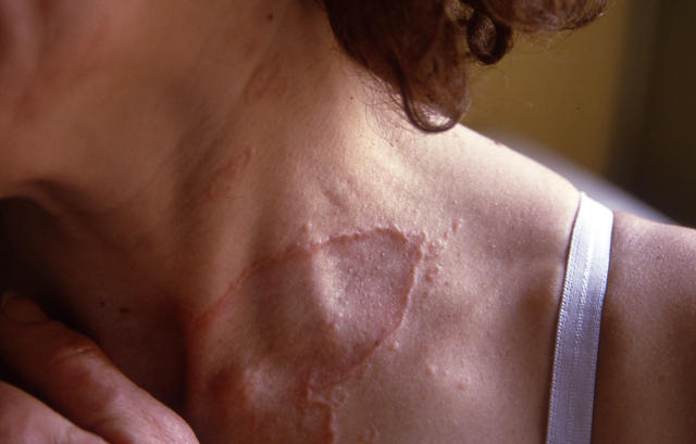 NECROBIOTIC DISORDERS - Granuloma Annulare, multiple NECROBIOTIC DISORDERS - Granuloma Annulare, multiple