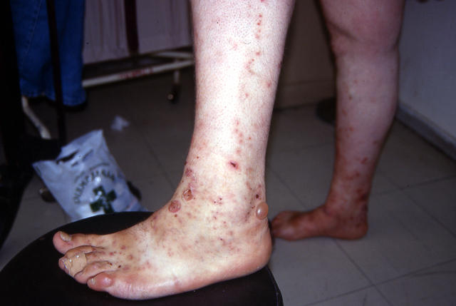 PARASITOSES, BITES - Insect bites PARASITOSES, BITES - Insect bites