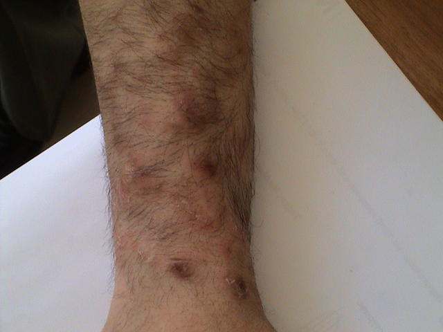 SUPERFICIAL FUNGAL INFECTIONS - Tinea Incognita SUPERFICIAL FUNGAL INFECTIONS - Tinea Incognita