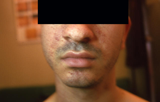 GENODERMATOSES - Tuberous sclerosis complex GENODERMATOSES - Tuberous sclerosis complex