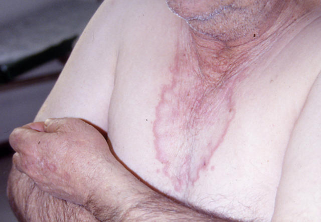 NECROBIOTIC DISORDERS - Granuloma Annulare